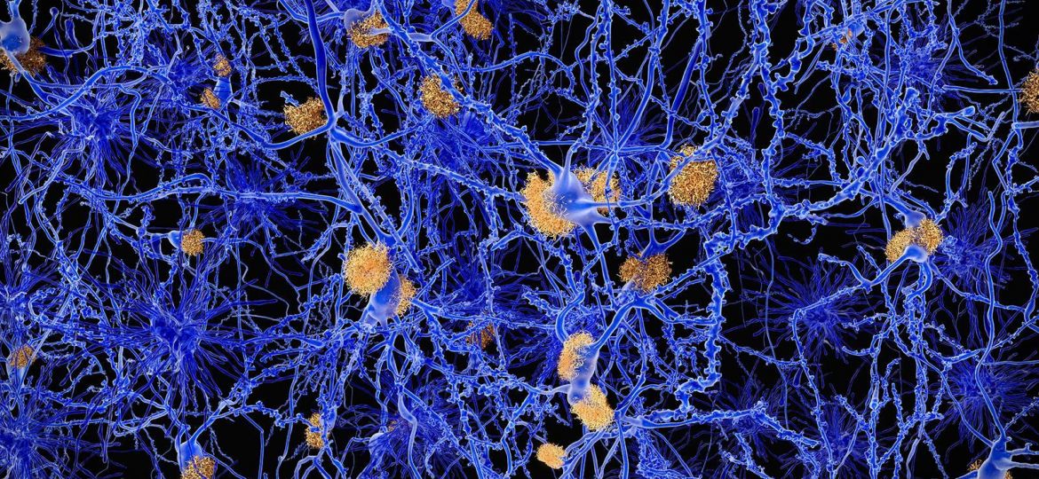 BIO CBD kapljice in Alzheimerjeva bolezen